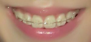 淮安牙科医院牙齿矫正